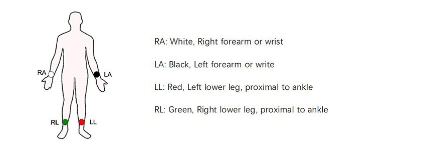 This is a description of the position of limb electrode This is a description of the position of limb electrode